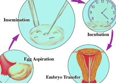 In Vitro Fertilization Process